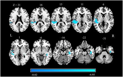 Structural and Functional Brain Changes in Patients With Classic Trigeminal Neuralgia: A Combination of Voxel-Based Morphometry and Resting-State Functional MRI Study